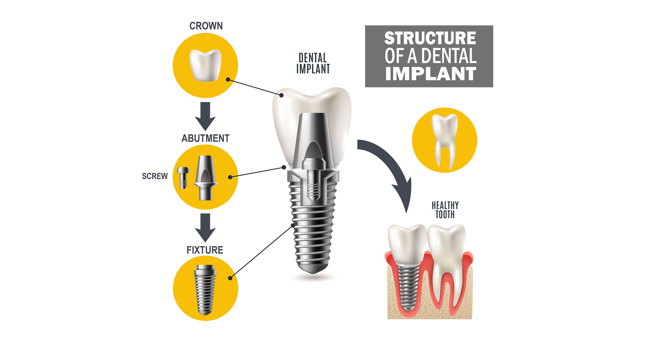 Titanium Dental Implant Structure Diagram showing Crown, Abutment, and Titanium Fixture